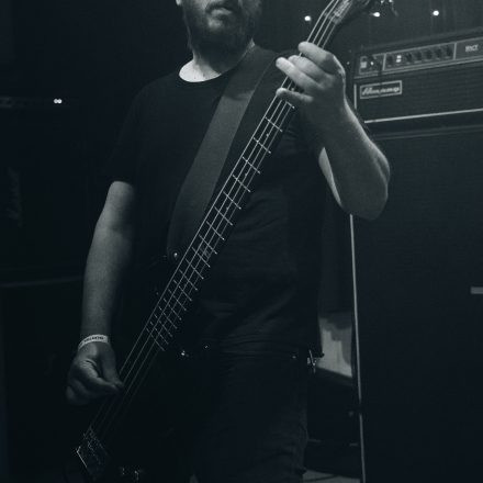 Teratoma